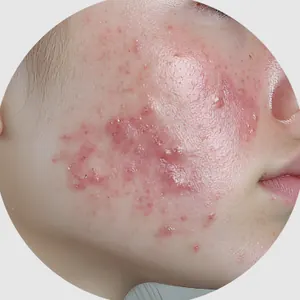 炎症ニキビ(赤ニキビ)
